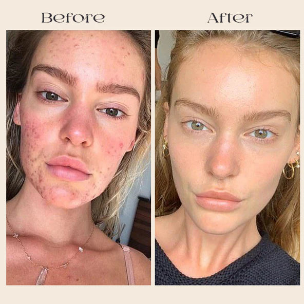 FavoPrime™ Arbutin 7% + Tranexamic Acid 4% Cream