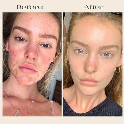 FavoPrime™ Arbutin 7% + Tranexamic Acid 4% Cream