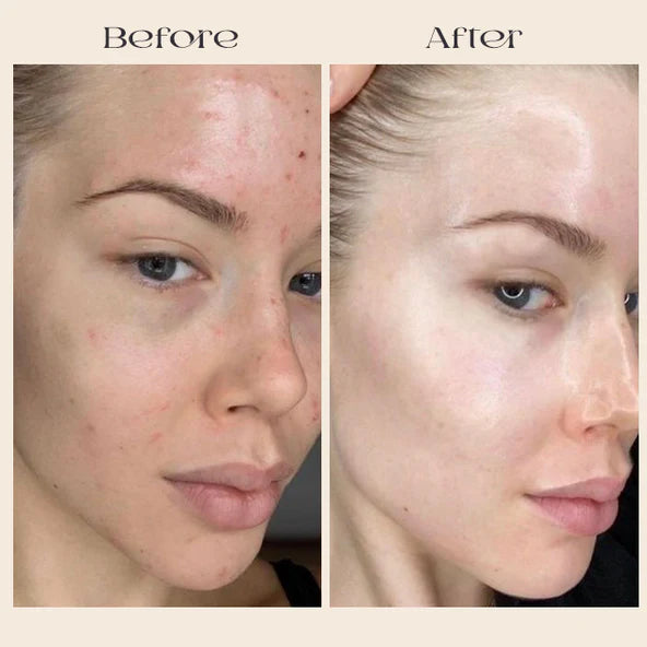 FavoPrime™ Arbutin 7% + Tranexamic Acid 4% Cream