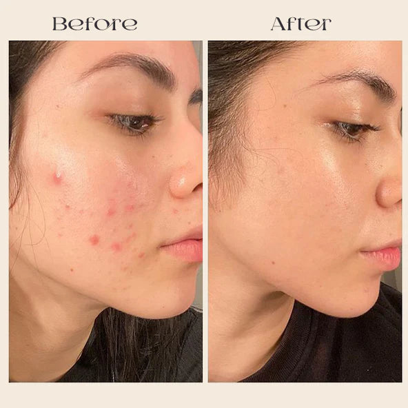 FavoPrime™ Arbutin 7% + Tranexamic Acid 4% Cream