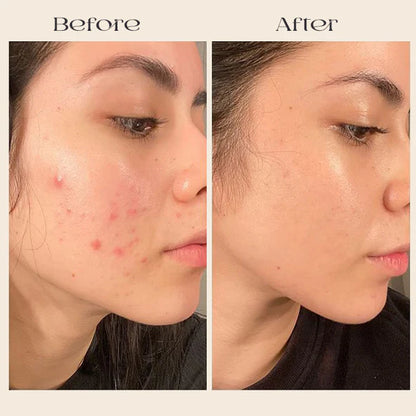 FavoPrime™ Arbutin 7% + Tranexamic Acid 4% Cream