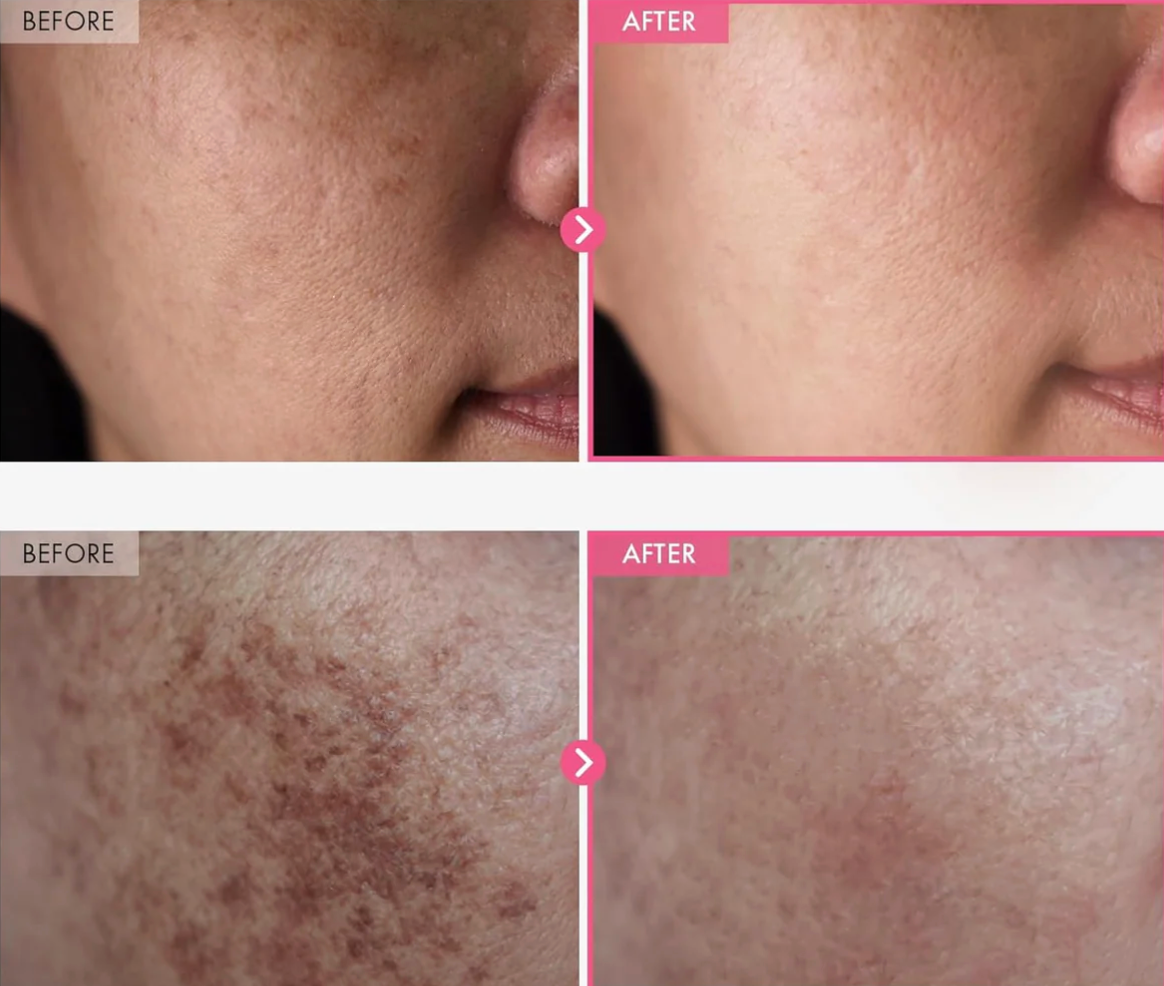 FavoPrime™ Arbutin 7% + Tranexamic Acid 4% Cream