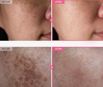 FavoPrime™ Arbutin 7% + Tranexamic Acid 4% Cream